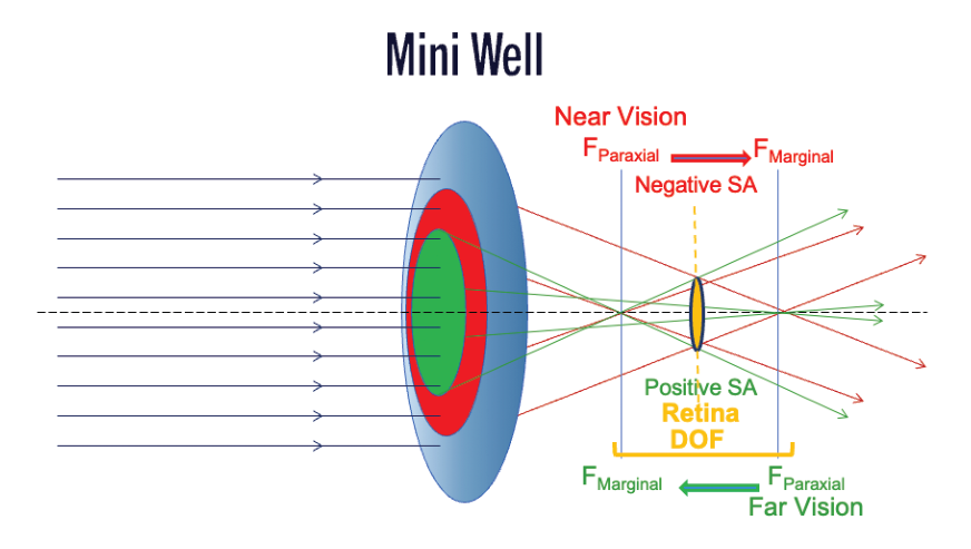 Figure 2. Positive and negative spherical aberration zones creating depth of field on the retina